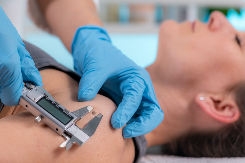 Dermatology Doctor Measures Mole with Digital Caliper Measuring Tool