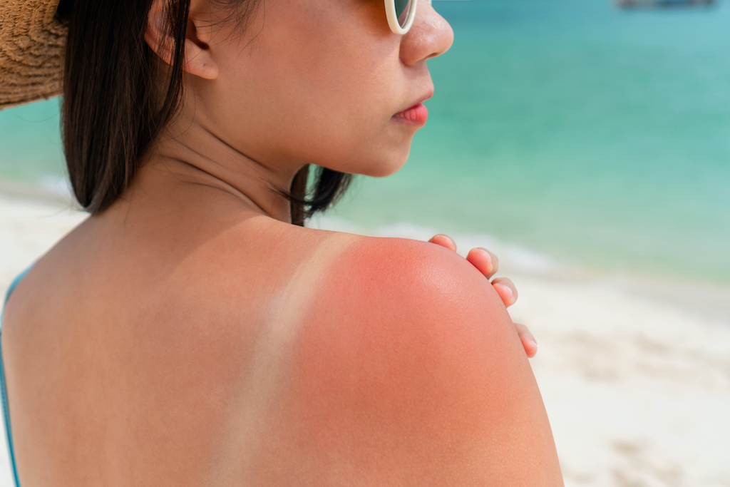 Sunburned skin on shoulder of a woman because of not using cream with sunscreen protection. Red skin sun burn after Sunbathing at the beach. Summer and holiday concept